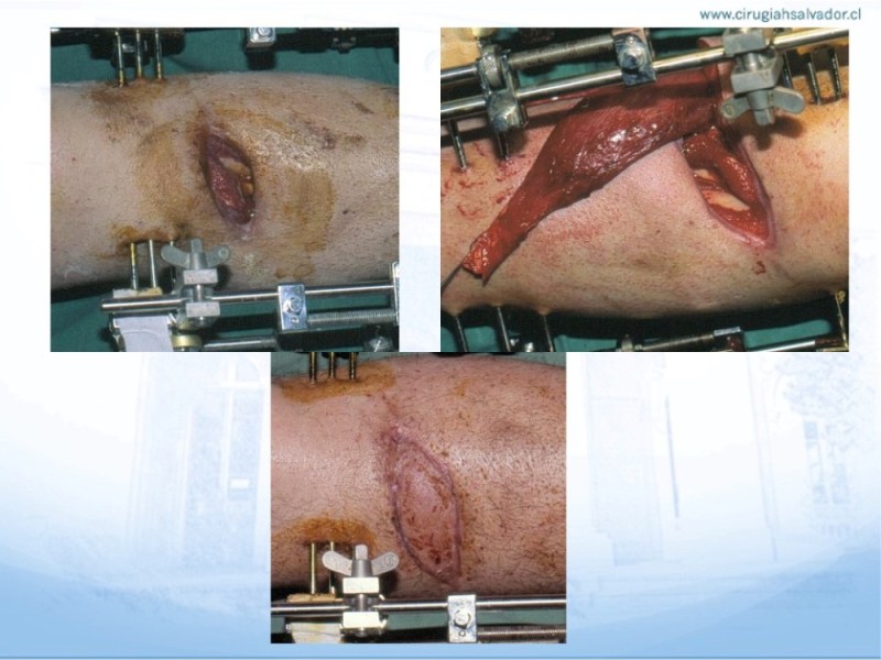 Diapositiva 33 de Reconstrucción miembro inferior