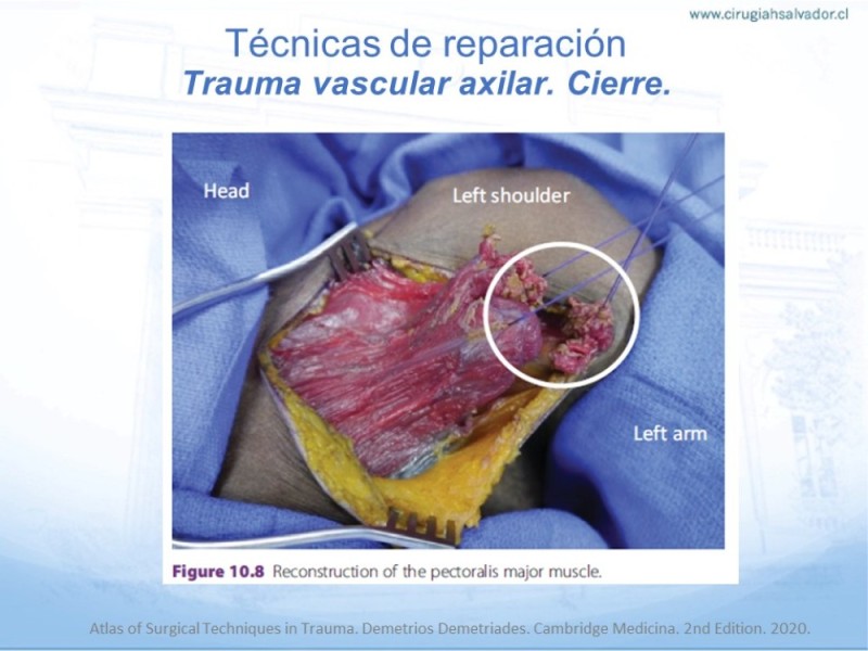 Diapositiva 25 de Trauma Vascular en Extremidad Severamente Lesionada Técnicas de reparación