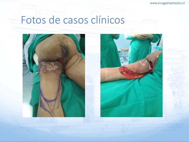 Diapositiva 42 de Lesiones por presión