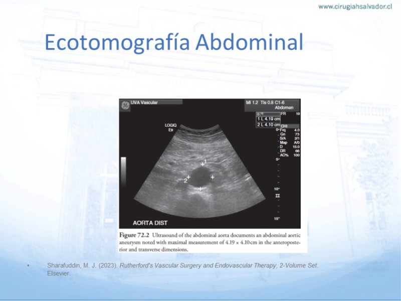 Diapositiva 9 de Aneurisma Aorta Abdominal: Abordaje infrarrenal - clamp supracelíaco