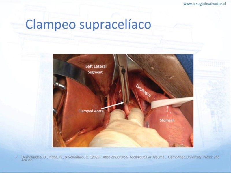 Diapositiva 26 de Aneurisma Aorta Abdominal: Abordaje infrarrenal - clamp supracelíaco