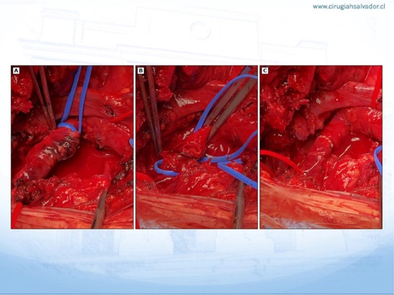 Diapositiva 15 de Trauma vascular cervical