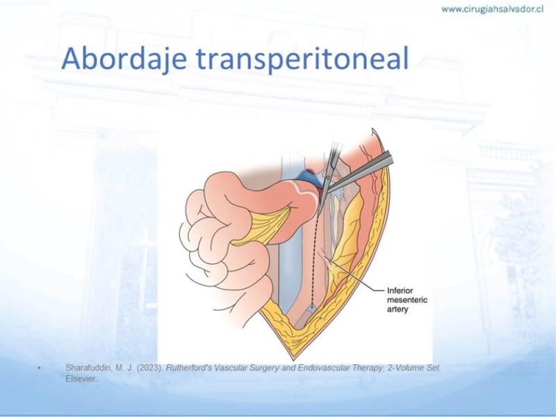 Diapositiva 18 de Aneurisma Aorta Abdominal: Abordaje infrarrenal - clamp supracelíaco