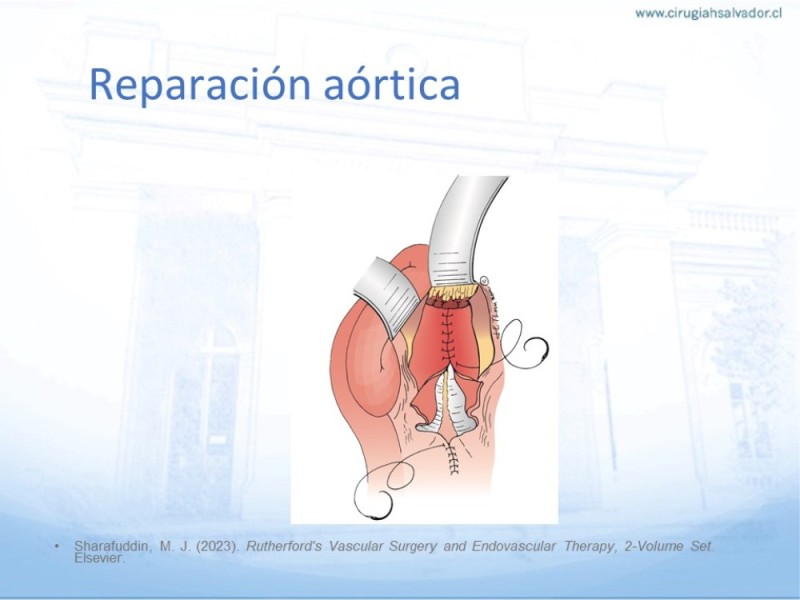 Diapositiva 30 de Aneurisma Aorta Abdominal: Abordaje infrarrenal - clamp supracelíaco