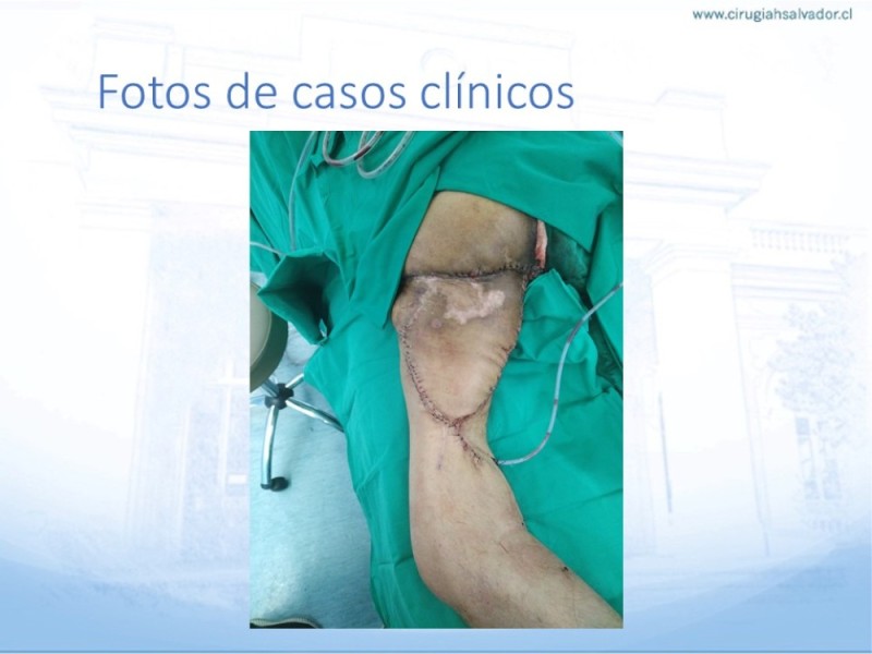 Diapositiva 43 de Lesiones por presión