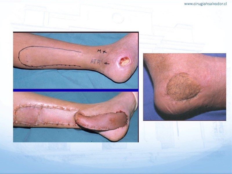 Diapositiva 43 de Reconstrucción miembro inferior