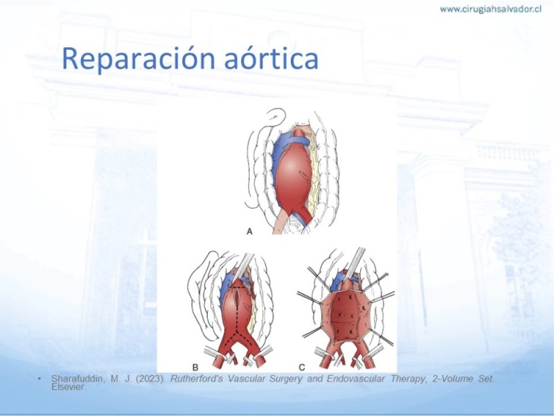 Diapositiva 28 de Aneurisma Aorta Abdominal: Abordaje infrarrenal - clamp supracelíaco