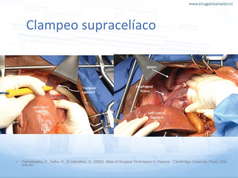 Diapositiva 22 de Aneurisma Aorta Abdominal: Abordaje infrarrenal - clamp supracelíaco