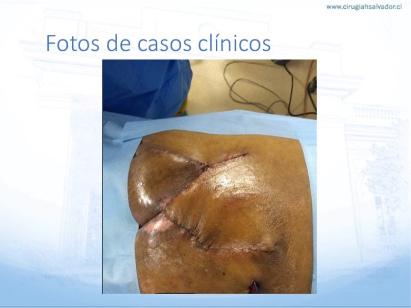 Diapositiva 38 de Lesiones por presión