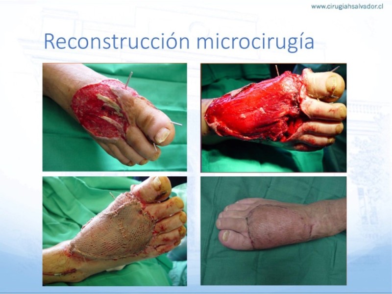 Diapositiva 48 de Reconstrucción miembro inferior