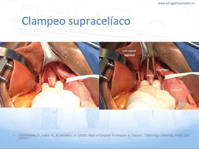Diapositiva 25 de Aneurisma Aorta Abdominal: Abordaje infrarrenal - clamp supracelíaco