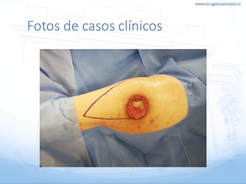 Diapositiva 40 de Lesiones por presión