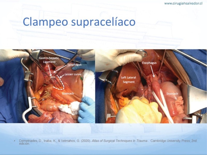 Diapositiva 23 de Aneurisma Aorta Abdominal: Abordaje infrarrenal - clamp supracelíaco