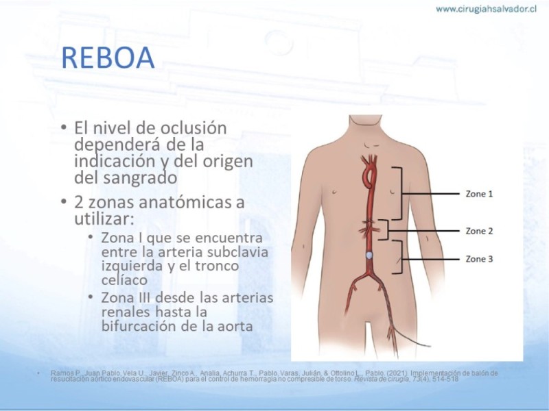 Diapositiva 32 de Aneurisma Aorta Abdominal: Abordaje infrarrenal - clamp supracelíaco
