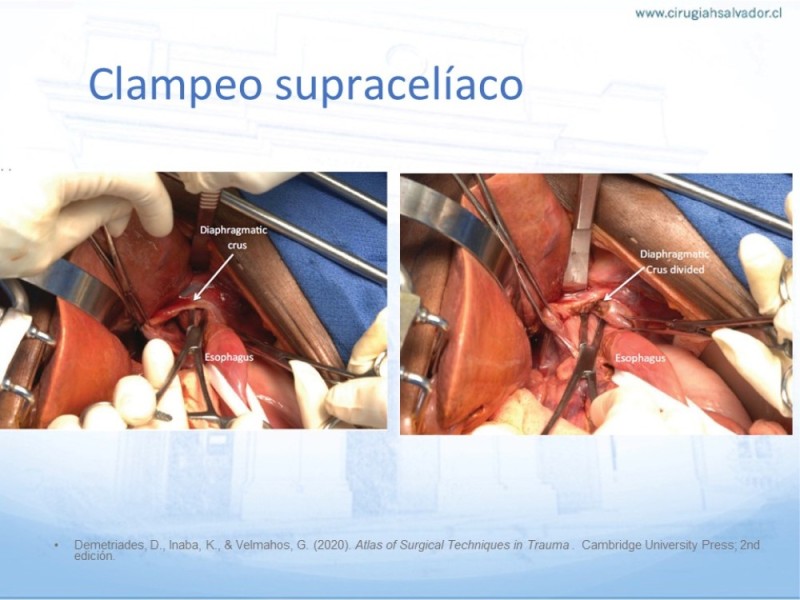 Diapositiva 24 de Aneurisma Aorta Abdominal: Abordaje infrarrenal - clamp supracelíaco