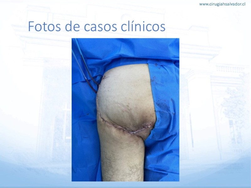 Diapositiva 45 de Lesiones por presión