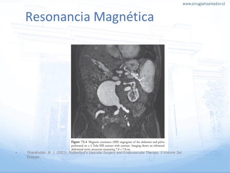 Diapositiva 11 de Aneurisma Aorta Abdominal: Abordaje infrarrenal - clamp supracelíaco